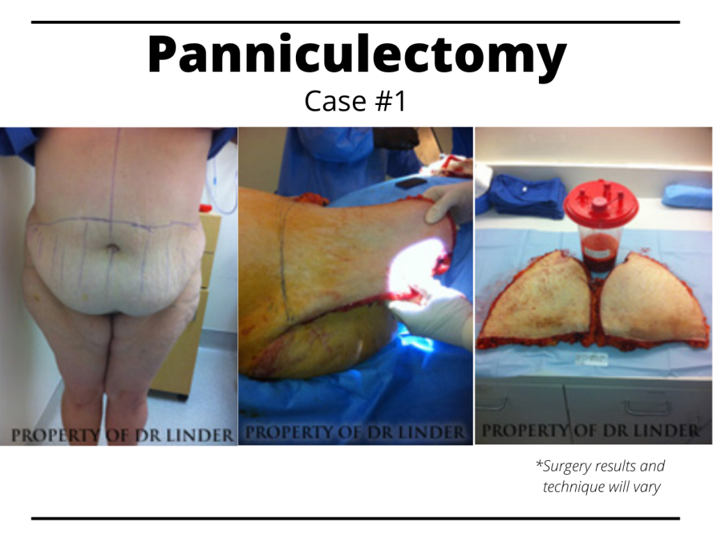 What's the Difference Between Panniculectomy and Tummy Tuck