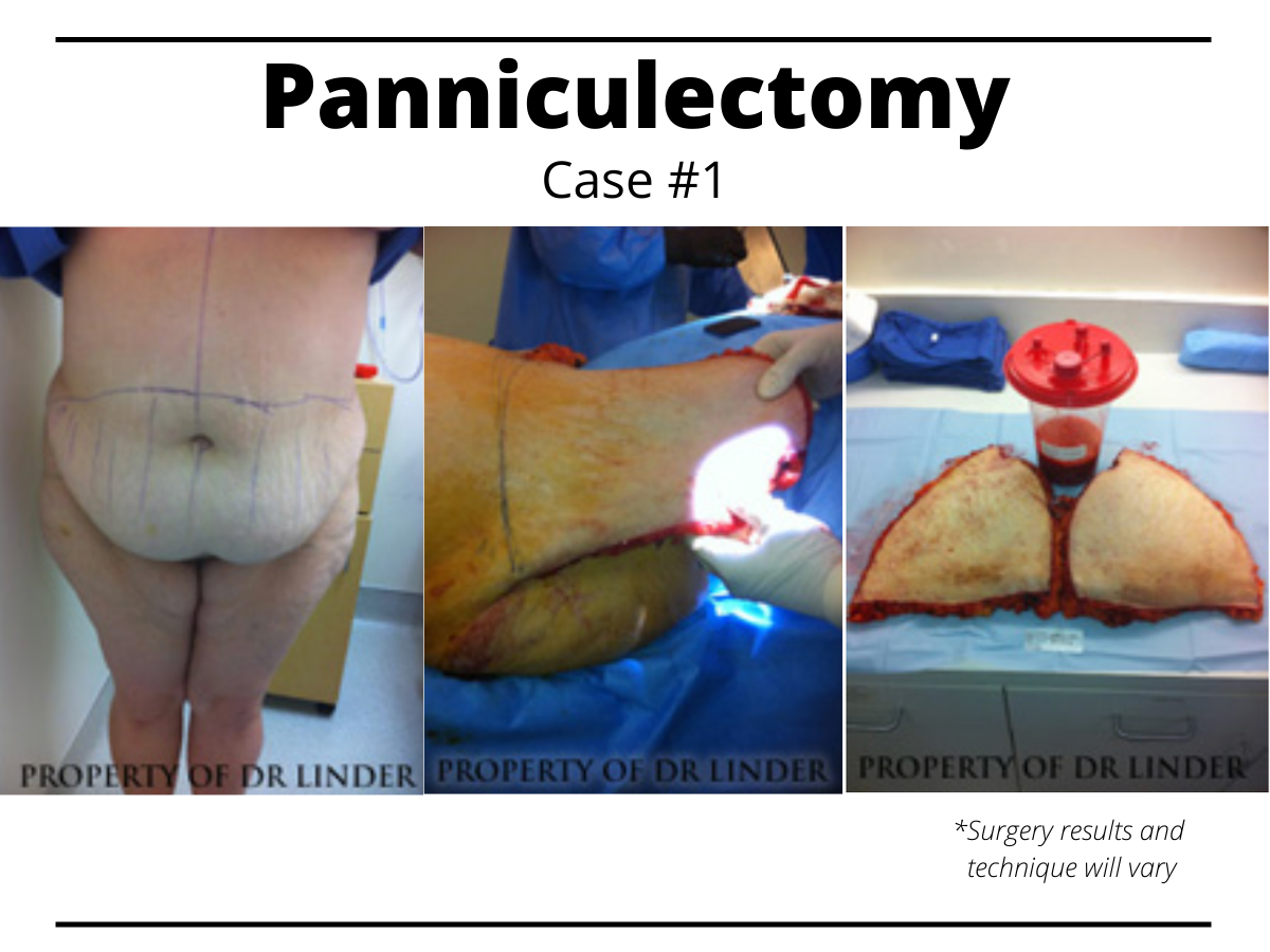 What Should You Expect During Your Panniculectomy?