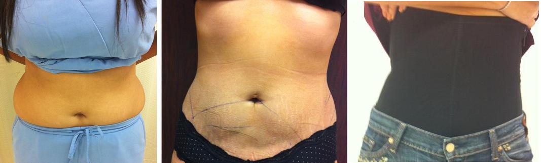 Tummy Tuck or Liposuction: Which Is the Better Solution for Your Muffin  Top?: Best Impression Med Spa: Medical Spa