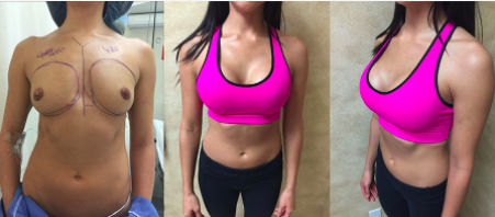How to do a Breast Augmentation For Thin, Athletic Women