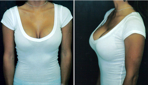 7 Advantages of High Profile Breast Implants