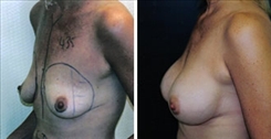 Breast Augmentation Patient Before & After Photo 1