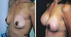 Breast Augmentation Patient Before & After Photo 1