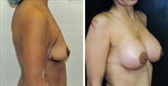 Breast Augmentation Patient Before & After Photo 1