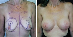 Breast Augmentation Patient Before & After Photo 1