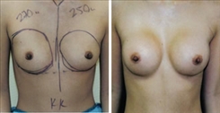 Breast Augmentation Patient Before & After Photo 1