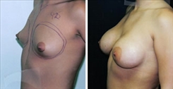 Breast Augmentation Patient Before & After Photo 1