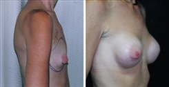 Breast Augmentation Patient Before & After Photo 1