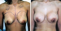 Breast Augmentation Patient Before & After Photo 1