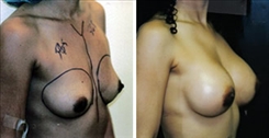 Breast Augmentation Patient Before & After Photo 1