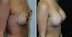 Breast Augmentation Patient Before & After Photo 1