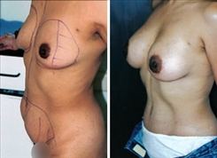 Breast Augmentation Patient Before & After Photo 1