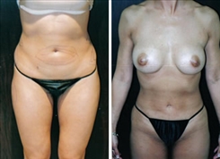 Breast Augmentation Patient Before & After Photo 1