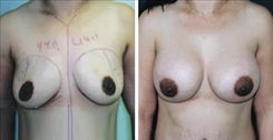 Breast Augmentation Patient Before & After Photo 1