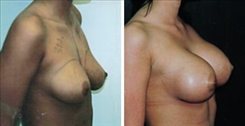 Breast Augmentation Patient Before & After Photo 1