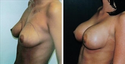 Breast Augmentation Patient Before & After Photo 1