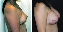 Breast Augmentation Patient Before & After Photo 1