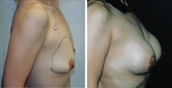 Breast Augmentation Patient Before & After Photo 1