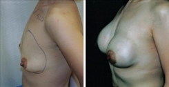 Breast Augmentation Patient Before & After Photo 1