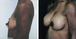 Breast Augmentation Patient Before & After Photo 1