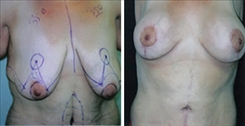 Breast Augmentation Patient Before & After Photo 1