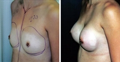 Breast Augmentation Patient Before & After Photo 1