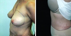 Breast Augmentation Patient Before & After Photo 1