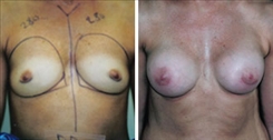 Breast Augmentation Patient Before & After Photo 1