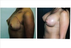 Breast Augmentation Patient Before & After Photo 1