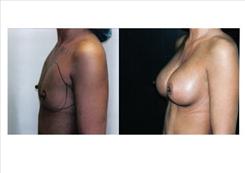 Breast Augmentation Patient Before & After Photo 1