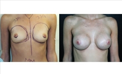 Breast Augmentation Patient Before & After Photo 1