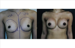 Breast Augmentation Patient Before & After Photo 1