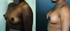 Breast Augmentation Patient Before & After Photo 1