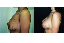 Breast Augmentation Patient Before & After Photo 1