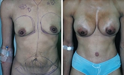 Breast Augmentation Patient Before & After Photo 1