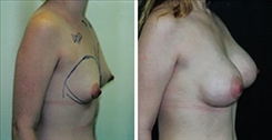 Breast Augmentation Patient Before & After Photo 1