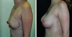 Breast Augmentation Patient Before & After Photo 1