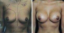 Breast Augmentation Patient Before & After Photo 1