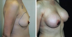 Breast Augmentation Patient Before & After Photo 1