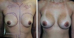 Breast Augmentation Patient Before & After Photo 1