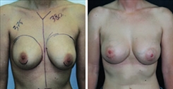 Breast Augmentation Patient Before & After Photo 1