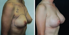 Breast Augmentation Patient Before & After Photo 1