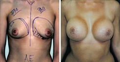 Breast Augmentation Patient Before & After Photo 1