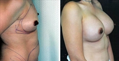 Breast Augmentation Patient Before & After Photo 1