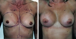 Breast Augmentation Patient Before & After Photo 1