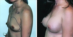 Breast Augmentation Patient Before & After Photo 1