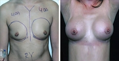 Breast Augmentation Patient Before & After Photo 1