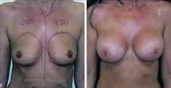 Breast Augmentation Patient Before & After Photo 1