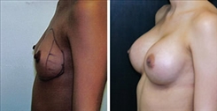 Breast Augmentation Patient Before & After Photo 1