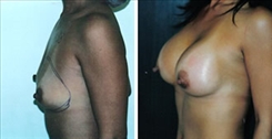 Breast Augmentation Patient Before & After Photo 1